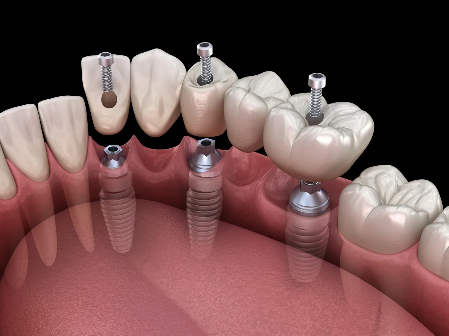 Jaki jest koszt implantów całej szczęki?